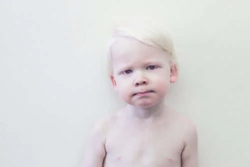 Copil care se întreabă ce este albinismul
