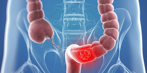 Desen ilustrând un blocaj intestinal