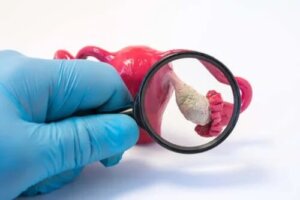 Extirparea prematură a ovarelor