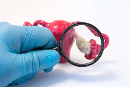 Extirparea prematură a ovarelor