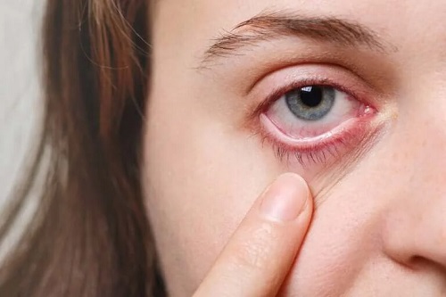 Fată cu migrenă oculară