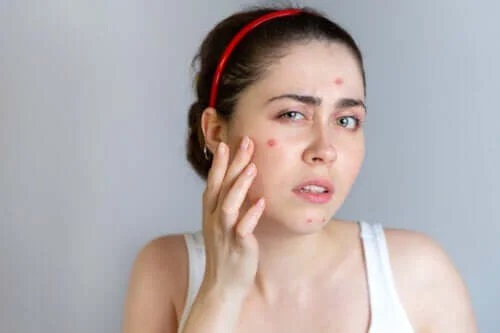 Totul despre acnee: cauze, tratamente eficiente si preventie
