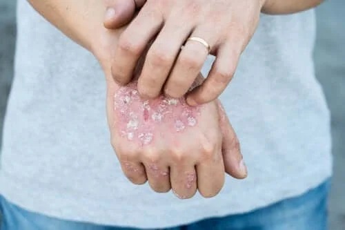 Femeie care are psoriazis