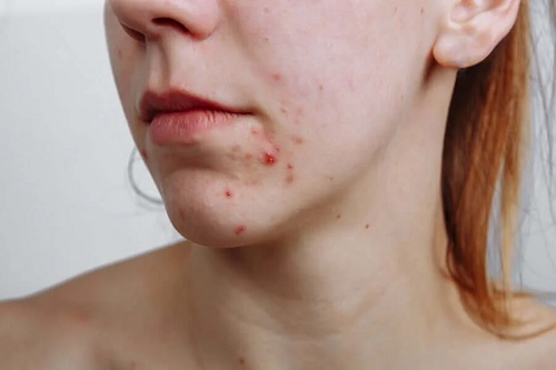 Femeie care necesită tratamente pentru acnee