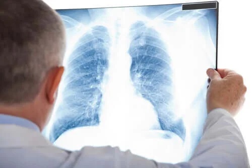 Medic care explică ce este un nodul pulmonar