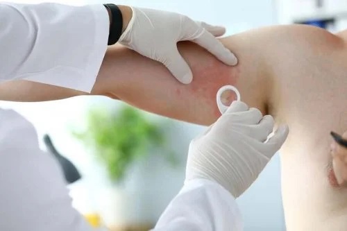 Medic ce examinează simptomele rozaceei