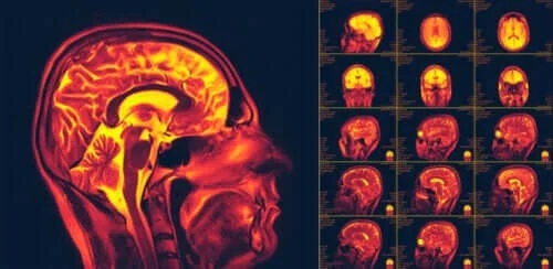 Ce este neuroplasticitatea creierului?