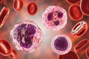 Nivelul ridicat de monocite în sânge: simptome