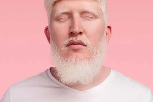 Persoană care suferă de albinism