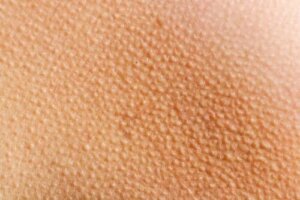 Piloerecția: de ce apare pielea de găină?