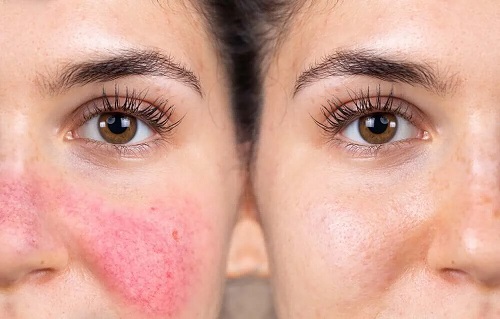 Pielea reactivă versus pielea normală