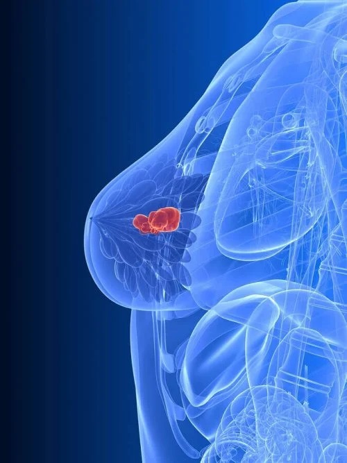 Sân afectat de cancer