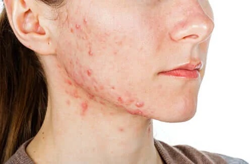 Tânără care nesesită tratamentul cu isotretinoin