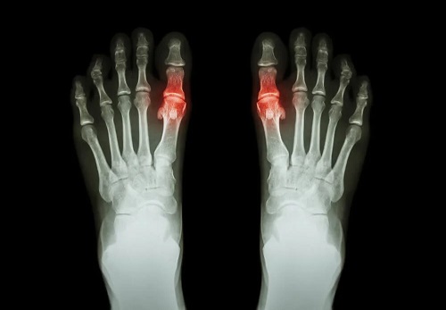 Artrita la radiografie