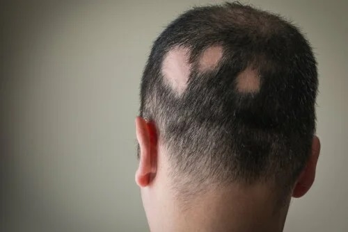 Bărbat cu alopecie