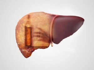 Simptome și tratamente pentru hepatita alcoolică