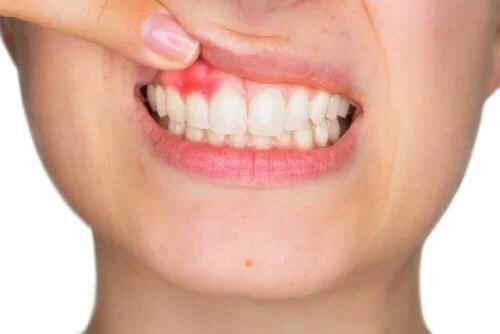 Persoană cu gingivită