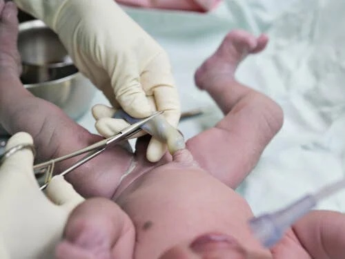 Medic care taie cordonul ombilical