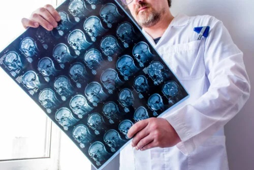 Medic care analizează tipurile de epilepsie