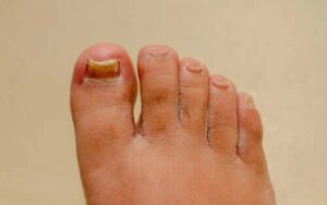 Ce tratamente pentru onicomicoză funcționează?