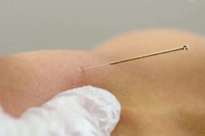 Terapia dry needling - descriere și beneficii