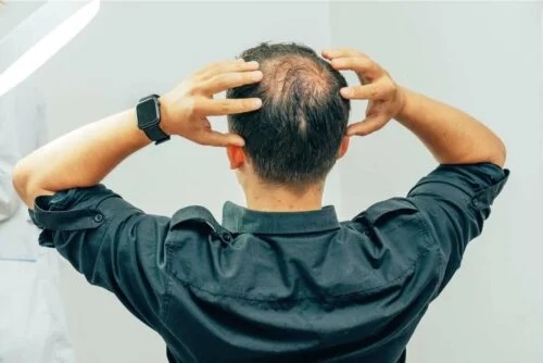 Tipurile de alopecie masculină