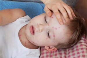 Cum se tratează urticaria la copii?