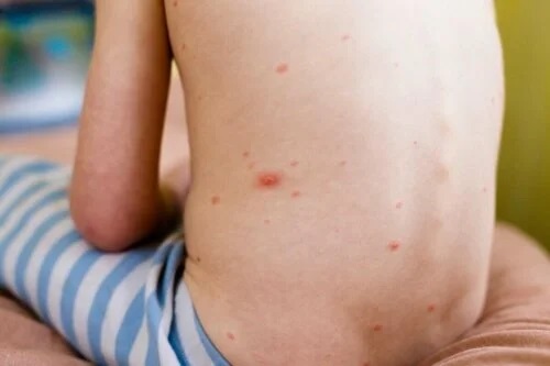 Urticaria la copii manifestată pe spate