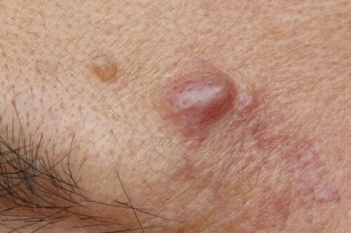 Chist epidermoid