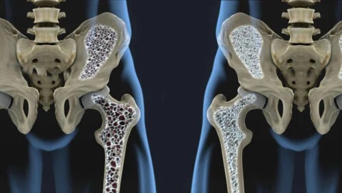 Factorii de risc asociați osteoporozei afectează oasele
