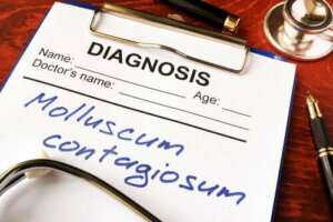 Ce este Molluscum contagiosum?