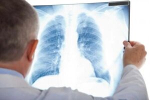 Ce este pneumonia atipică?