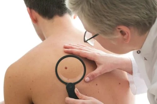 Medic care recomandă tratamentul dermatofibromului