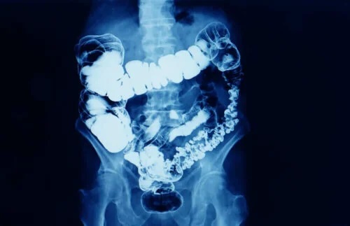 Sindromul de colon iritabil la radiografie