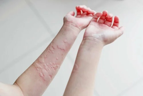 Pecient cu mai multe tipuri de urticare cronică