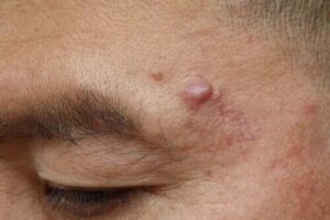 Cauze și tratamente pentru chisturile epidermoide