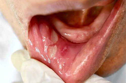 Specialist care explică ce este ulcerul bucal