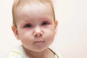 Conjunctivita la copii: ce trebuie să faci?