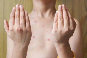 Herpesul zoster la copii: simptome și tratament