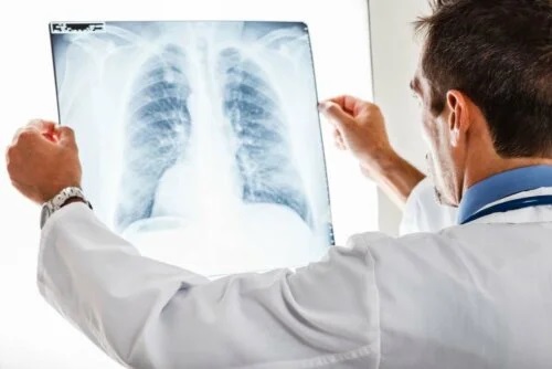 Medic ce explică dacă bronșita este contagioasă