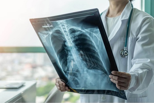 Medic ce explică simptomele tuberculozei pulmonare