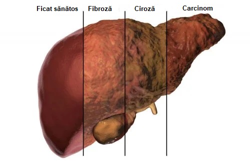Metabolismul ficatului care duce la ciroză