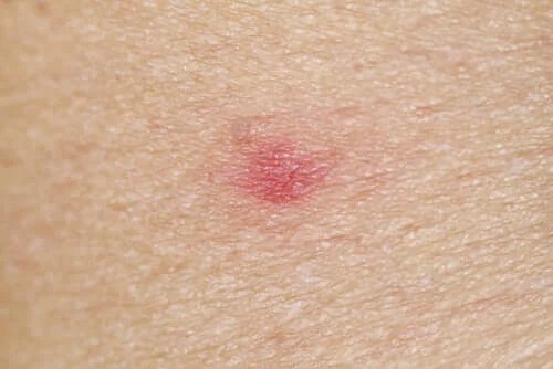 Mușcătură de insectă înroșită