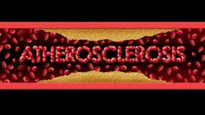 Simptome și tratamente pentru ateroscleroză