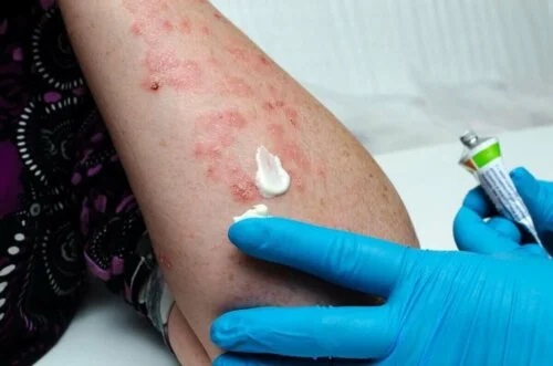 Persoană care are herpes zoster