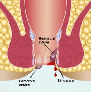 Ce este anoscopia? Informații importante