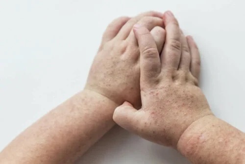 Scarlatina este contagioasă la copii