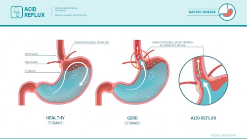 Reprezentare grafică a refluxului gastroesofagian