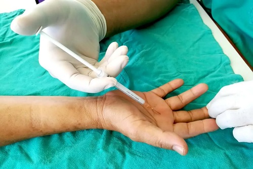 Medic ce tratează degetul blocat