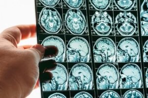 Hernia cerebrală sau hernierea creierului